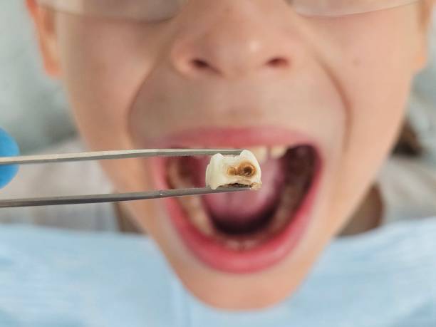 Best Emergency Wisdom Teeth Removal in South Shore, KY